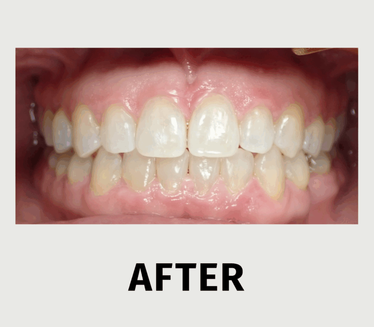 Close Your Gap 3 - After