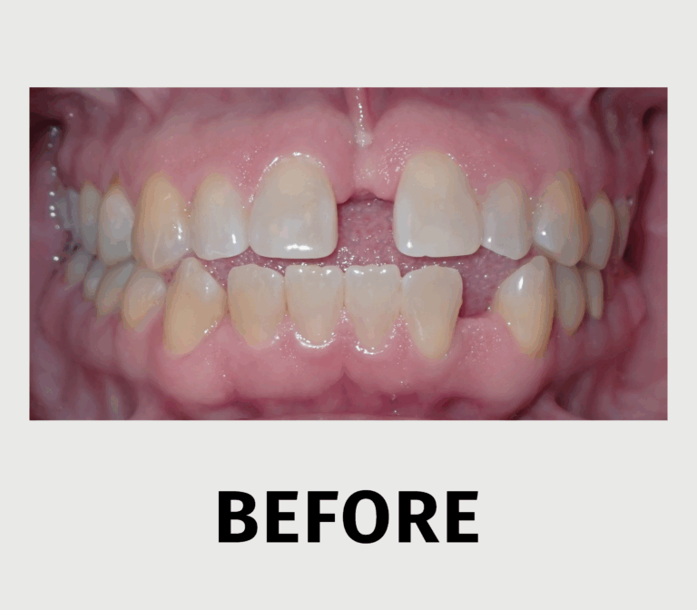 Close Your Gap 3 - before