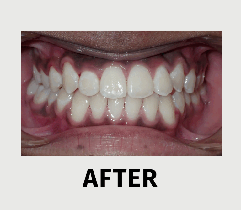 FIX YOUR BITE - after