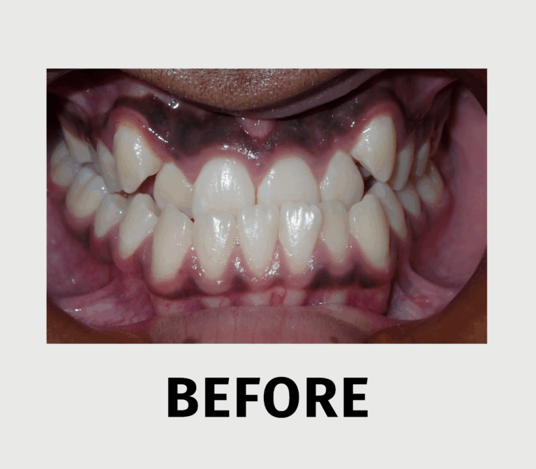 FIX YOUR BITE - before