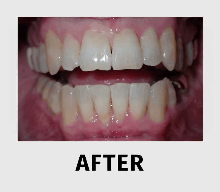 Uncrowd Your Teeth - after