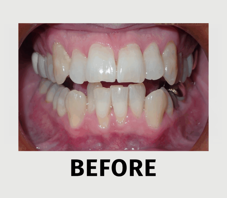 Uncrowd Your Teeth - before